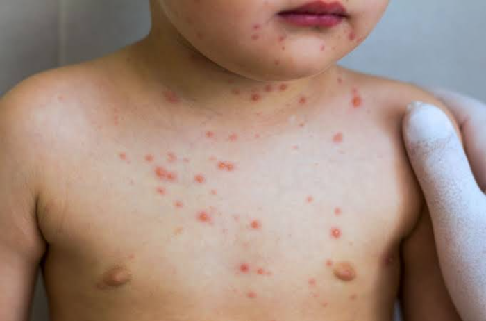 ظهور حالات إصابة بالجدري.. وتحذيرات طبية من سرعة الانتشار